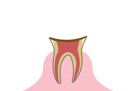 虫歯の症状 段階4