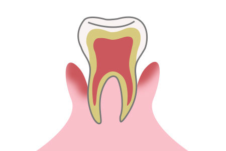 虫歯の症状 段階1 歯肉炎