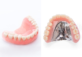 総入れ歯の種類
