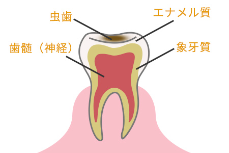 虫歯の症状 段階1