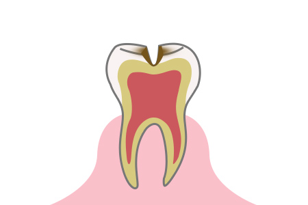 虫歯の症状 段階2