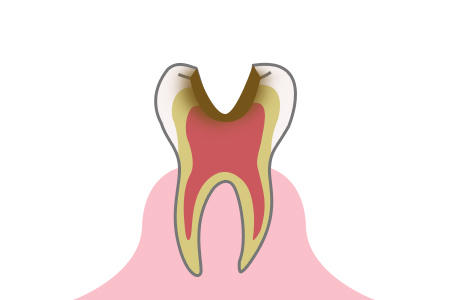 虫歯の症状 段階3
