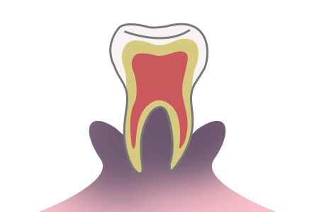 虫歯の症状 段階2 歯周炎